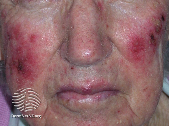 File:Actinic Keratoses treated with imiquimod (DermNet NZ lesions-ak-imiquimod-3757).jpg
