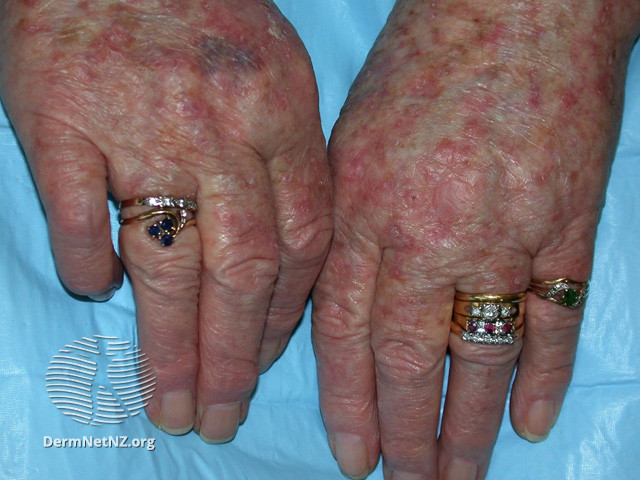 File:Actinic keratoses affecting the hands (DermNet NZ lesions-ak-hands-567).jpg