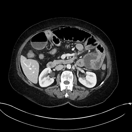 Active Crohn disease (Radiopaedia 59394-66750 Axial C+ portal venous phase 30).jpg