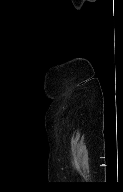 Active Crohn disease (Radiopaedia 59394-66750 Sagittal C+ portal venous phase 2).jpg