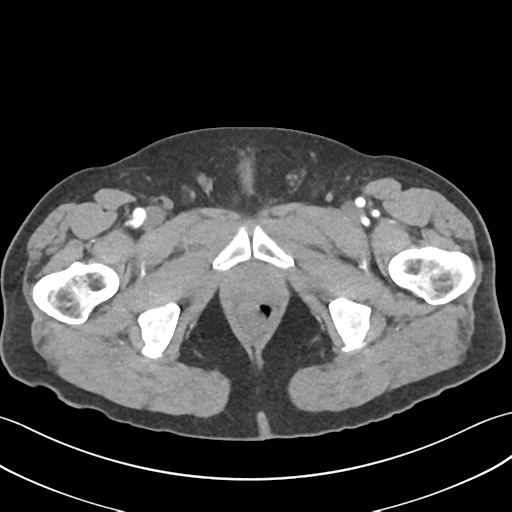 File:Active diverticular hemorrhage (Radiopaedia 39415-41725 Axial C+ arterial phase 75).png