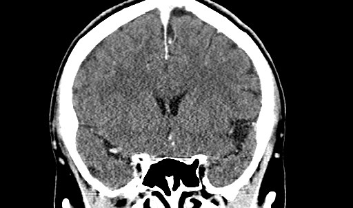 File:Active neurocysticercosis before and after therapy (Radiopaedia 71710-82099 Coronal C+ delayed 31).jpg