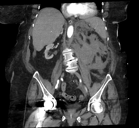 Active renal extravasation with large subcapsular and retroperitoneal hemorrhage (Radiopaedia 60975-68796 Coronal C+ arterial phase 88).jpg