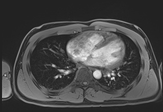 Active right ventricular cardiac sarcoidosis (Radiopaedia 55596-62100 Axial Post contrast Dixon 45).jpg