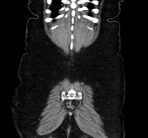 Acute appendicitis, heterotaxy syndrome (Radiopaedia 66884-76202 Coronal C+ portal venous phase 114).jpg
