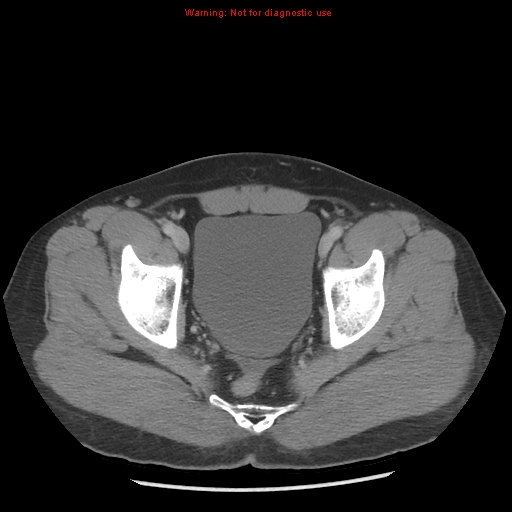 File:Acute appendicitis (Radiopaedia 10498-10973 Axial C+ portal venous phase 56).jpg
