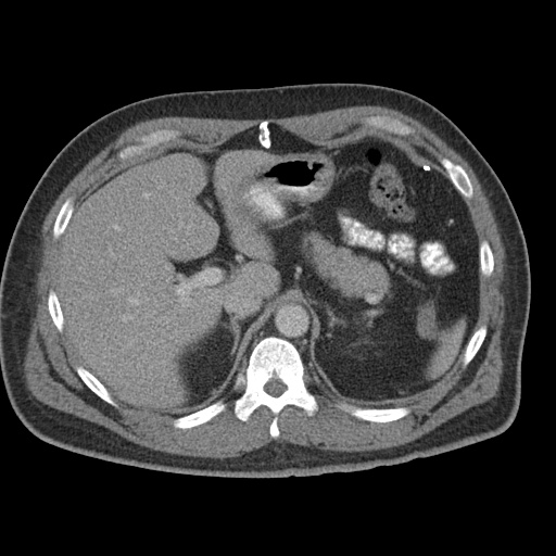 Acute appendicitis (Radiopaedia 48511-53463 Axial C+ portal venous phase 26).jpg