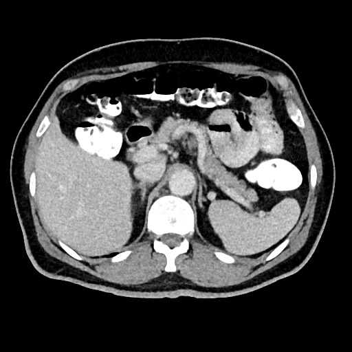 Acute appendicitis (Radiopaedia 77016-88960 Axial C+ portal venous phase 42).jpg