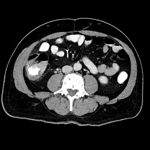 File:Acute appendicitis (Radiopaedia 77016-88960 Axial C+ portal venous phase 81).jpg