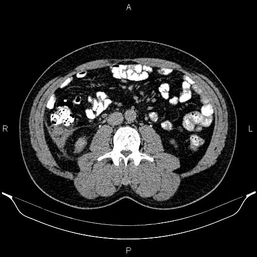 Acute appendicitis (Radiopaedia 84780-100240 Axial C+ delayed 53).jpg