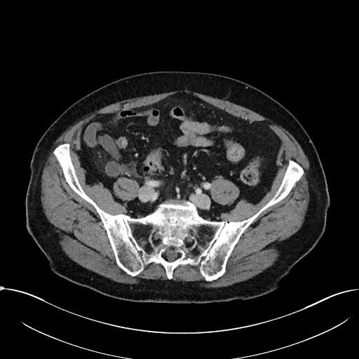 Acute appendicitis - large appendicoliths (Radiopaedia 61805-69820 Axial C+ portal venous phase 95).jpg
