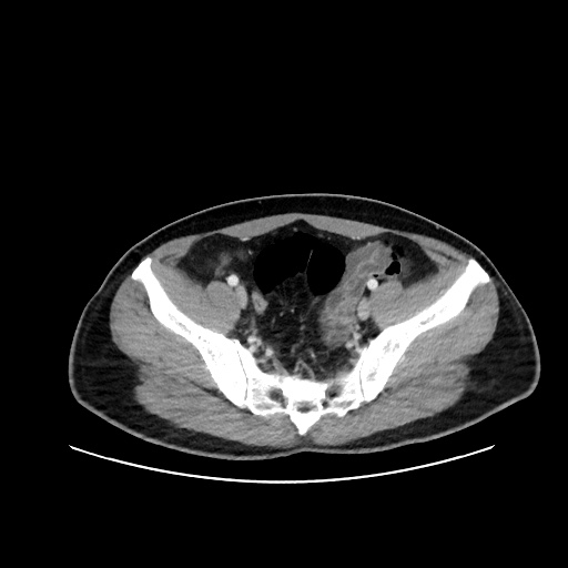 Acute appendicitis and COVID 19 pneumonia (Radiopaedia 76604-88380 Axial C+ portal venous phase 68).jpg