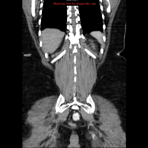 Acute appendicitis complicated by ovarian vein thrombophlebitis (Radiopaedia 16172-15851 Coronal C+ portal venous phase 67).jpg
