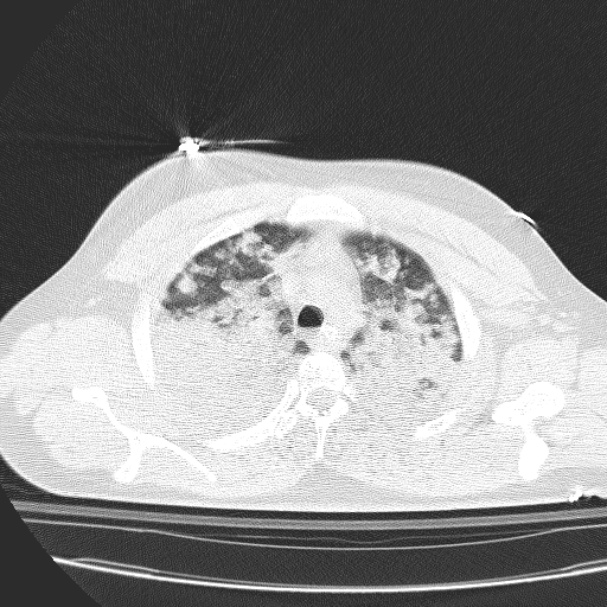 Acute aspiration pneumonitis (Radiopaedia 33605-34703 Axial lung window 28).jpg