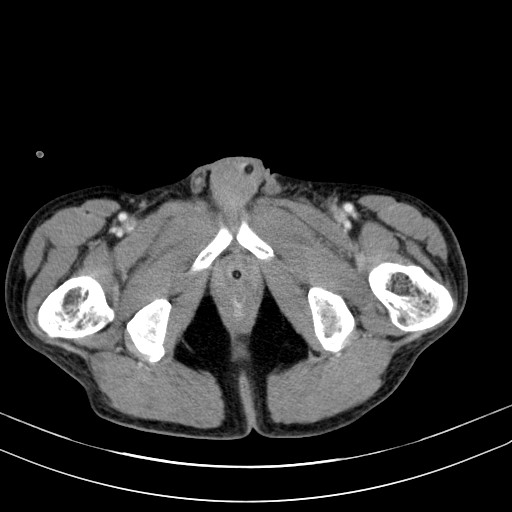 Acute bowel ischemia (Radiopaedia 87695-104114 Axial C+ portal venous phase 89).jpg