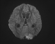 File:Acute cerebellar ataxia (Radiopaedia 61487-69446 Axial DWI 11).jpg