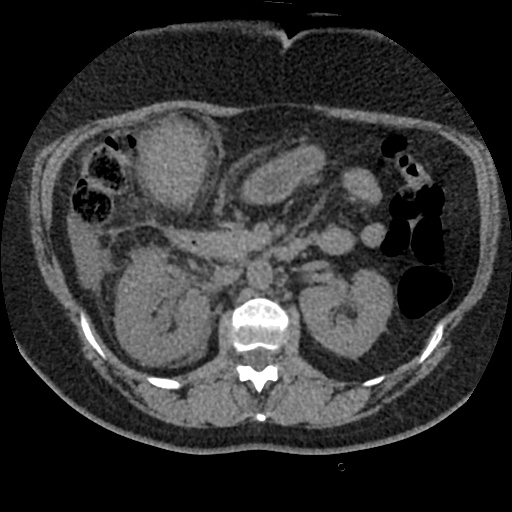 File:Acute cholecystitis and ureteric colic (Radiopaedia 42330-45444 Axial prone 35).jpg