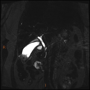 File:Acute cholecystitis with gallbladder neck calculus (Radiopaedia 42795-45971 Coronal Turbo spin echo 24).jpg