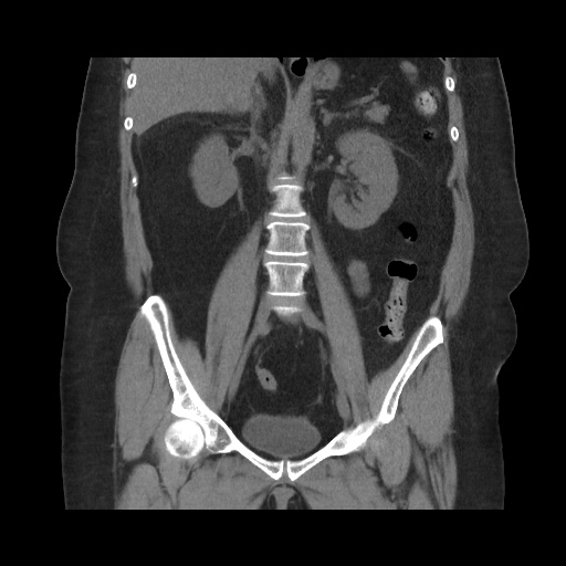 Acute cholecystitis with tensile fundus sign (Radiopaedia 71394-81723 Coronal non-contrast 72).jpg