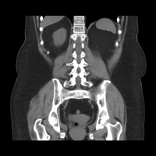 File:Acute cholecystitis with tensile fundus sign (Radiopaedia 71394-81723 Coronal non-contrast 87).jpg