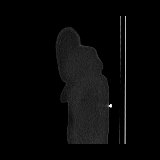 File:Acute cholecystitis with tensile fundus sign (Radiopaedia 71394-81723 Sagittal non-contrast 18).jpg