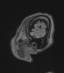 Acute disseminated encephalomyelitis (ADEM)- Anti-NMDA receptor encephalitis (Radiopaedia 54920-61201 Sagittal FLAIR 76).png