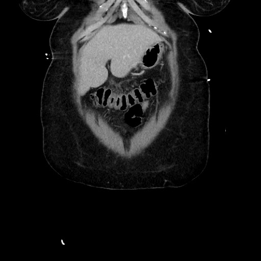 Acute diverticulitis - transverse colon (Radiopaedia 87063-103327 Coronal C+ portal venous phase 44).jpg