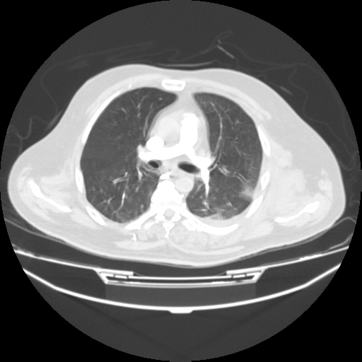 File:Acute heart failure (CT) (Radiopaedia 79835-93075 Axial lung window 20).png