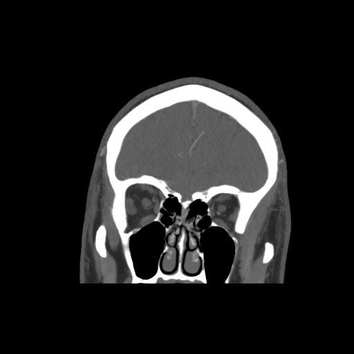 Acute internal carotid artery dissection (Radiopaedia 53541-59630 E 15).jpg