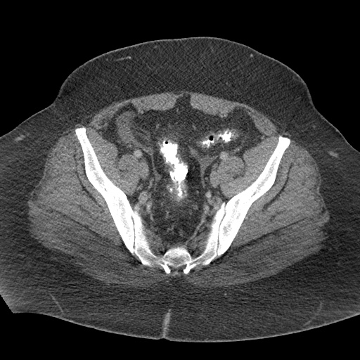 File:Acute mesenteric venous ischemia (Radiopaedia 46041-50383 Axial C+ portal venous phase 117).jpg