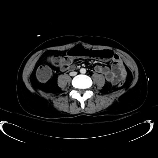 Acute myocardial infarction in CT (Radiopaedia 39947-42415 Axial C+ portal venous phase 78).jpg