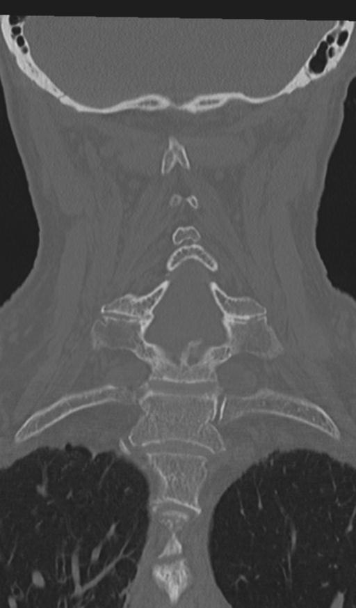 Acute on chronic subdural hematoma and thoracic vertebral injury in a multitrauma patient (Radiopaedia 31698-32619 Coronal bone window 38).jpg