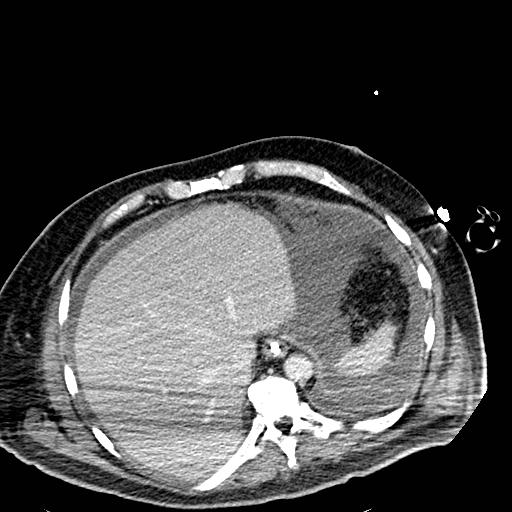 Acute pancreatic necrosis (Radiopaedia 13560-18501 Axial C+ portal venous phase 13).jpg