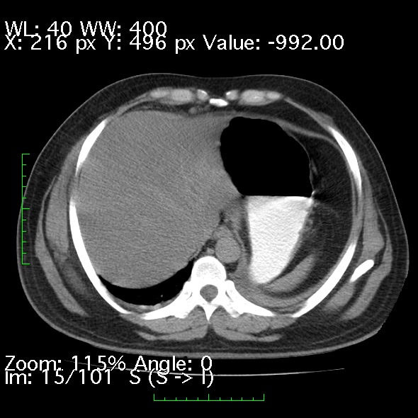 Acute pancreatitis (Radiopaedia 34043-35276 Axial non-contrast 15).jpg