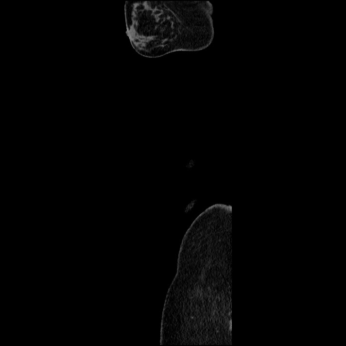 Acute pancreatitis (Radiopaedia 69236-79012 Sagittal C+ portal venous phase 5).jpg