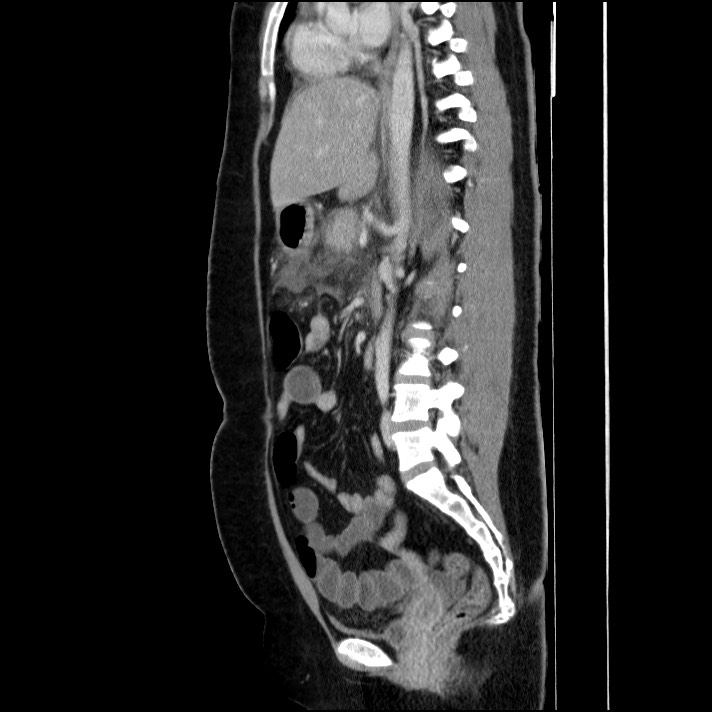 Acute pancreatitis (Radiopaedia 69236-79012 Sagittal C+ portal venous phase 50).jpg