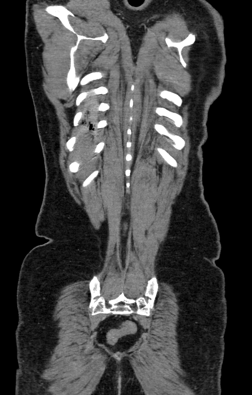 Acute pancreatitis (Radiopaedia 80007-93285 Coronal C+ portal venous phase 140).jpg