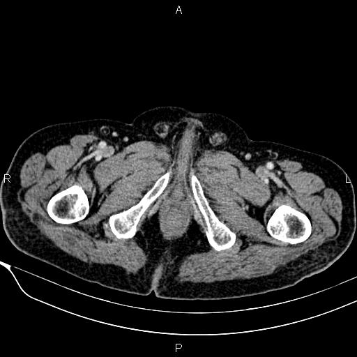 Acute pancreatitis (Radiopaedia 85146-100701 Axial C+ portal venous phase 67).jpg