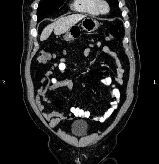 Acute pancreatitis (Radiopaedia 85390-101010 Coronal C+ portal venous phase 13).jpg