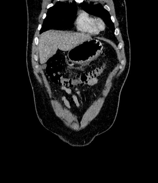 Acute pancreatitis (Radiopaedia 87428-103757 Coronal C+ portal venous phase 15).jpg