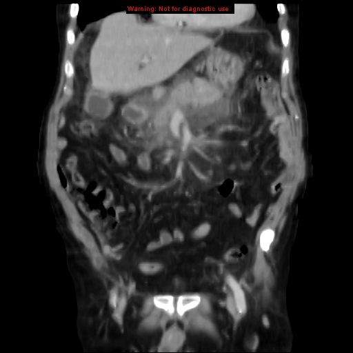 Acute pancreatitis with incidental pancreatic lipoma (Radiopaedia 10190-10730 Coronal C+ portal venous phase 24).jpg