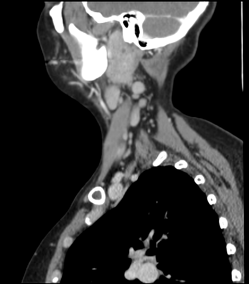 File:Acute parotitis (Radiopaedia 27425-27619 Sagittal C+ portal venous phase 15).png
