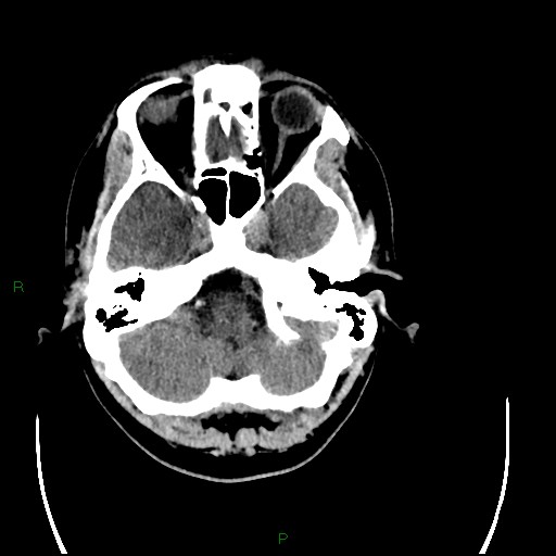 Acute posterior cerebral artery territory infarct (Radiopaedia 79329-92393 Axial non-contrast 21).jpg