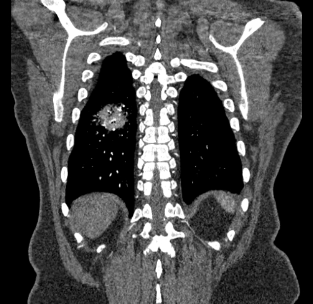 Acute pulmonary embolism with pulmonary infarcts (Radiopaedia 77688-89908 Coronal C+ CTPA 90).jpg