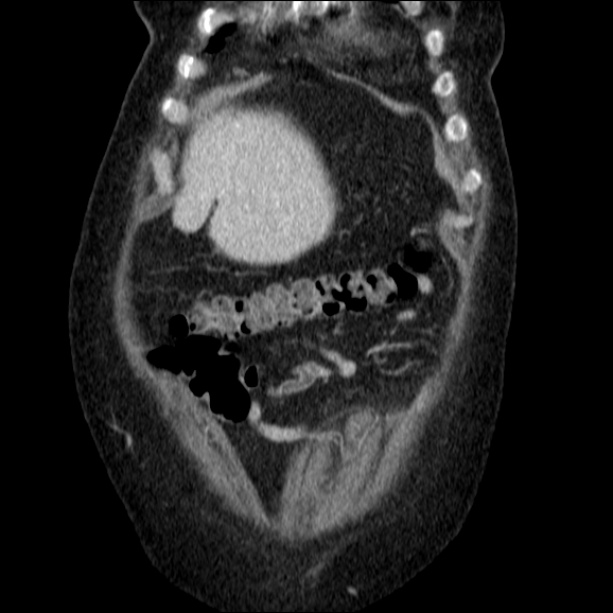 Acute pyelonephritis (Radiopaedia 26584-26729 C+ portal venous phase 15).jpg