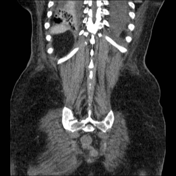 Acute pyelonephritis (Radiopaedia 26584-26729 C+ portal venous phase 63).jpg