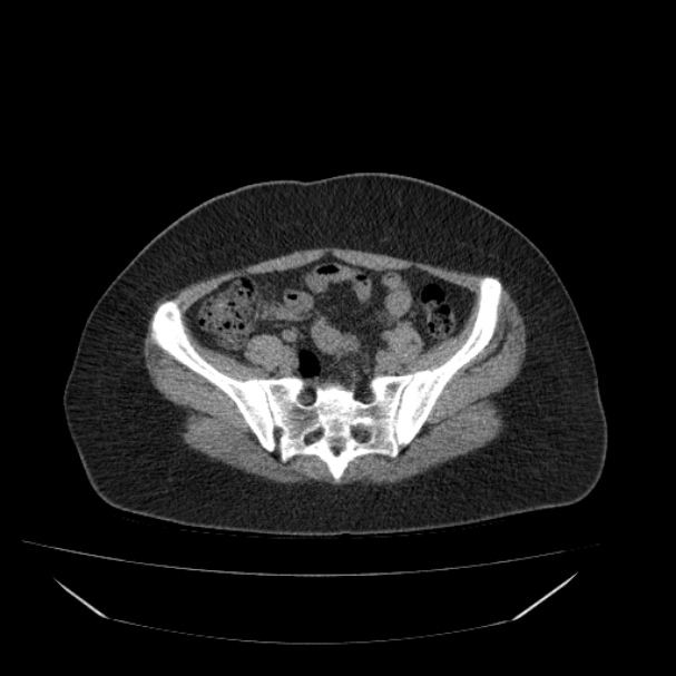 Acute pyelonephritis (Radiopaedia 33397-34434 Axial non-contrast 61).jpg