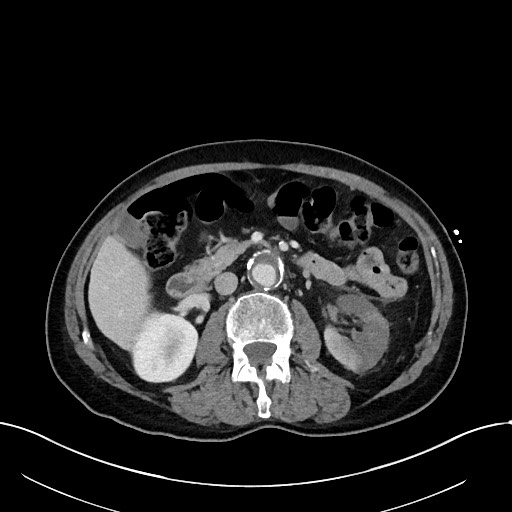 Acute renal infarction (Radiopaedia 59375-66736 Axial C+ portal venous phase 43).jpg