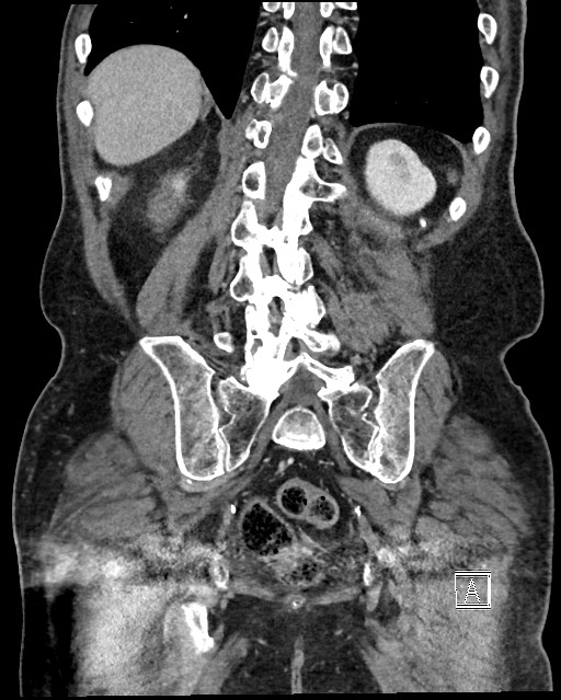 Acute renal infarction - rim capsular enhancement (Radiopaedia 59833-67270 Coronal C+ portal venous phase 50).jpg