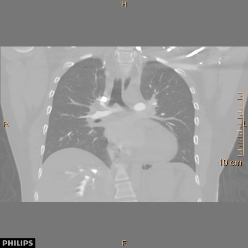 File:Acute reversible pulmonary hypertension and right heart failure from cocaine toxicity (Radiopaedia 49394-54517 Coronal C+ CTPA 24).jpg